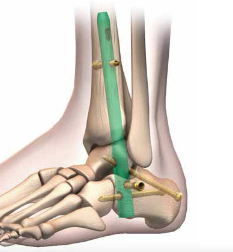 Smith & Nephew Hindfoot nail